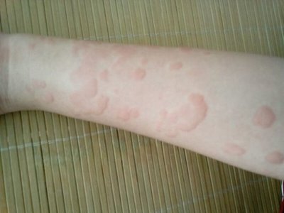 别再乱涂激素膏!重庆皮肤病名医团:荨麻疹需这样分型而治