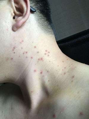 青春痘反复发作?重庆这家专研机构推出"痤疮分型诊疗",现在预