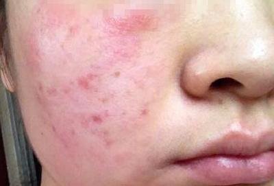 终于找到!重庆主城这家皮肤科藏着20年经验的过敏治疗专家